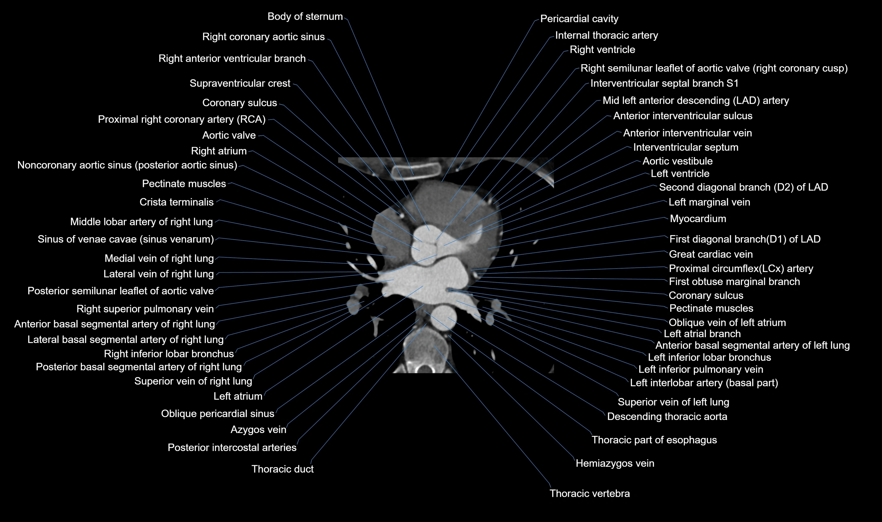 CT heart (coronary angiogram) axial view cross sectional anatomy labelled radiology image-00030.webp